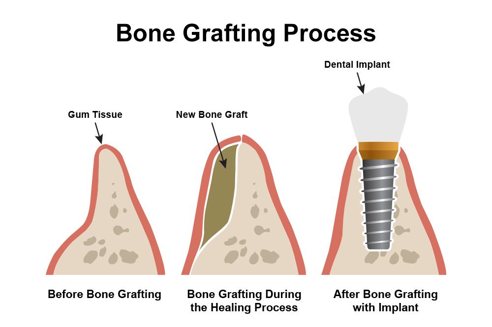 Bone grafting process