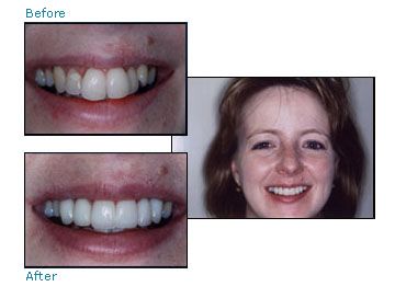 Before and after dental patient pictures