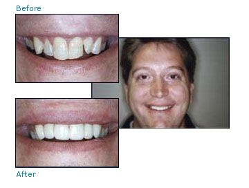 Before and after dental patient pictures