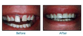Before and after dental patient pictures