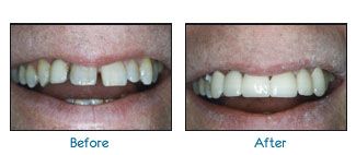 Before and after dental patient pictures
