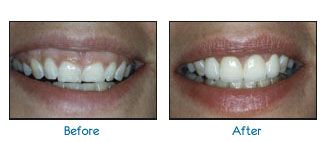 Before and after dental patient pictures