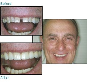 Before and after dental patient pictures
